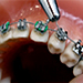 ortodoncia-lima-colocacion-brackets